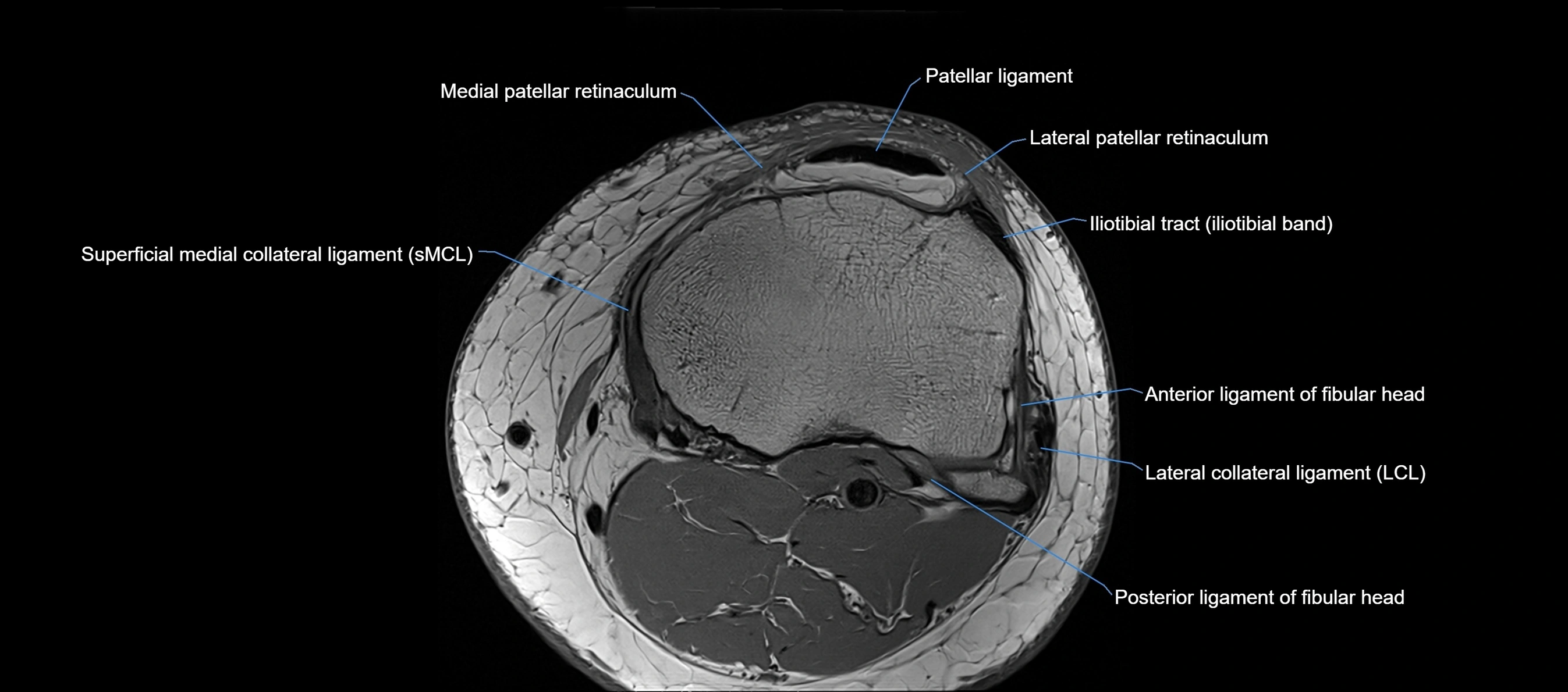 MRI Knee axial  ligaments cross sectional anatomy 3T  radiology  image-img-03001-00037.webp